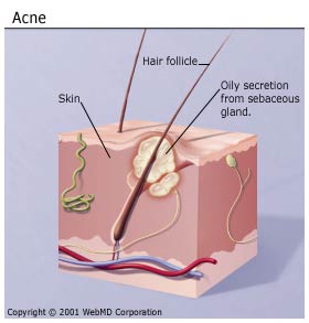 Severe Acne Treatments | skincareweekly